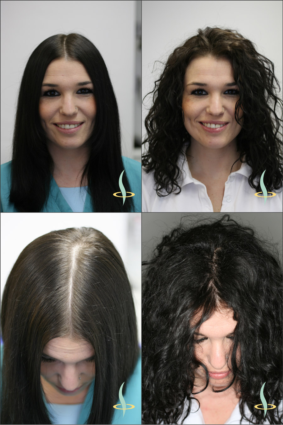 Abbildung 2: Optischer Effekt durch gerades (links) und lockiges (rechts) Haar auf die Sichtbarkeit der Kopfhaut. (Quelle: eigene Darstellung)