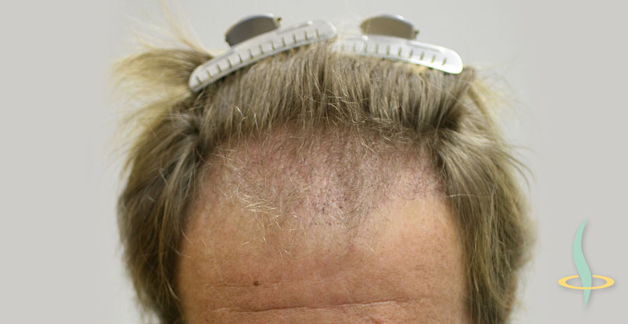 Abbildung 3: Stirnansatz des Patienten 3 Monate nach der ersten Operation