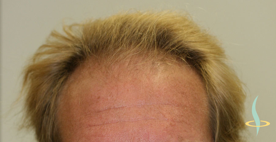 Abbildung 1: Stirnansatz des Patienten vor Behandlungsbeginn