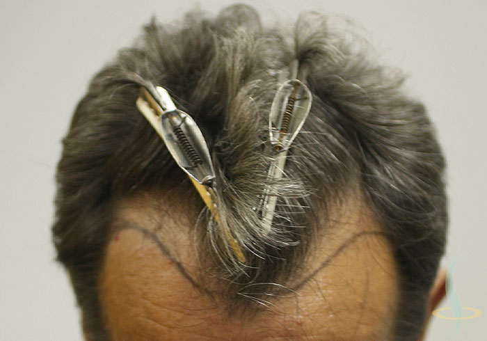 Vor der Operation (mit Haarlinie)